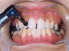 機器による歯垢・歯石・着色の除去の様子